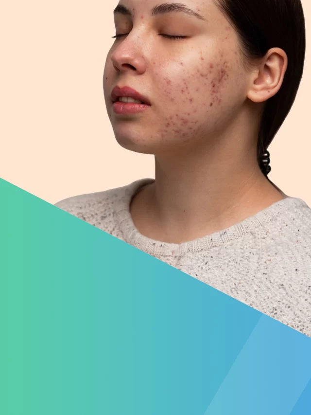 How to take care of  PCOS Acne: HealZen’s Holistic Approach